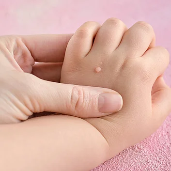 Warzen bei Kindern richtig entfernen