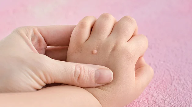 Warzen bei Kindern richtig entfernen