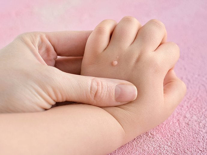 Warzen bei Kindern richtig entfernen