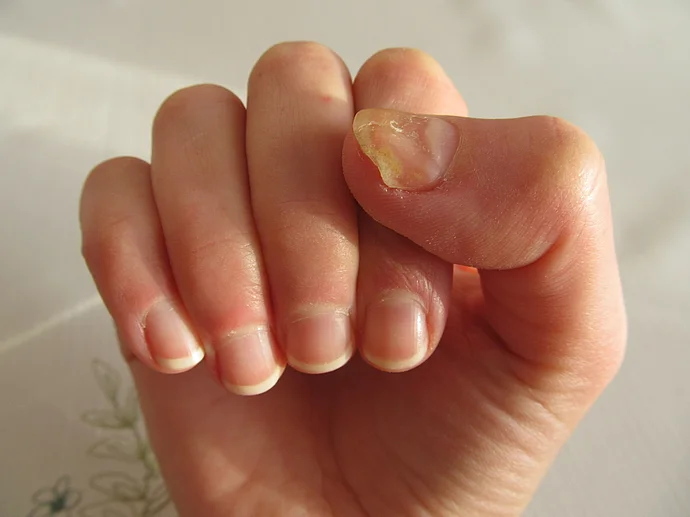 Nagelpilz an Händen