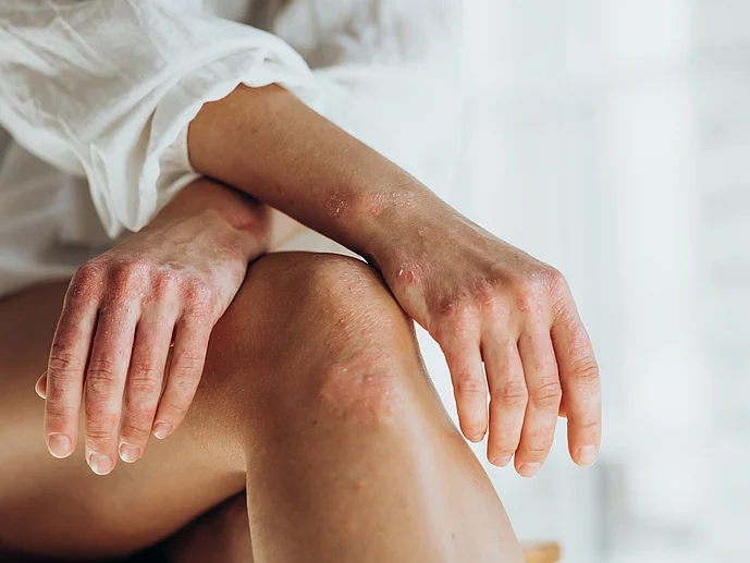 Schuppenflechte Psoriasis an Händen und Knie