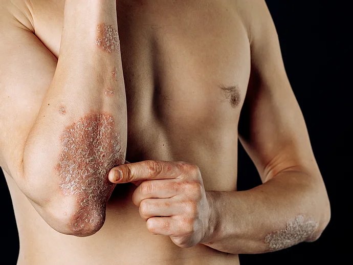Psoriasis am Arm