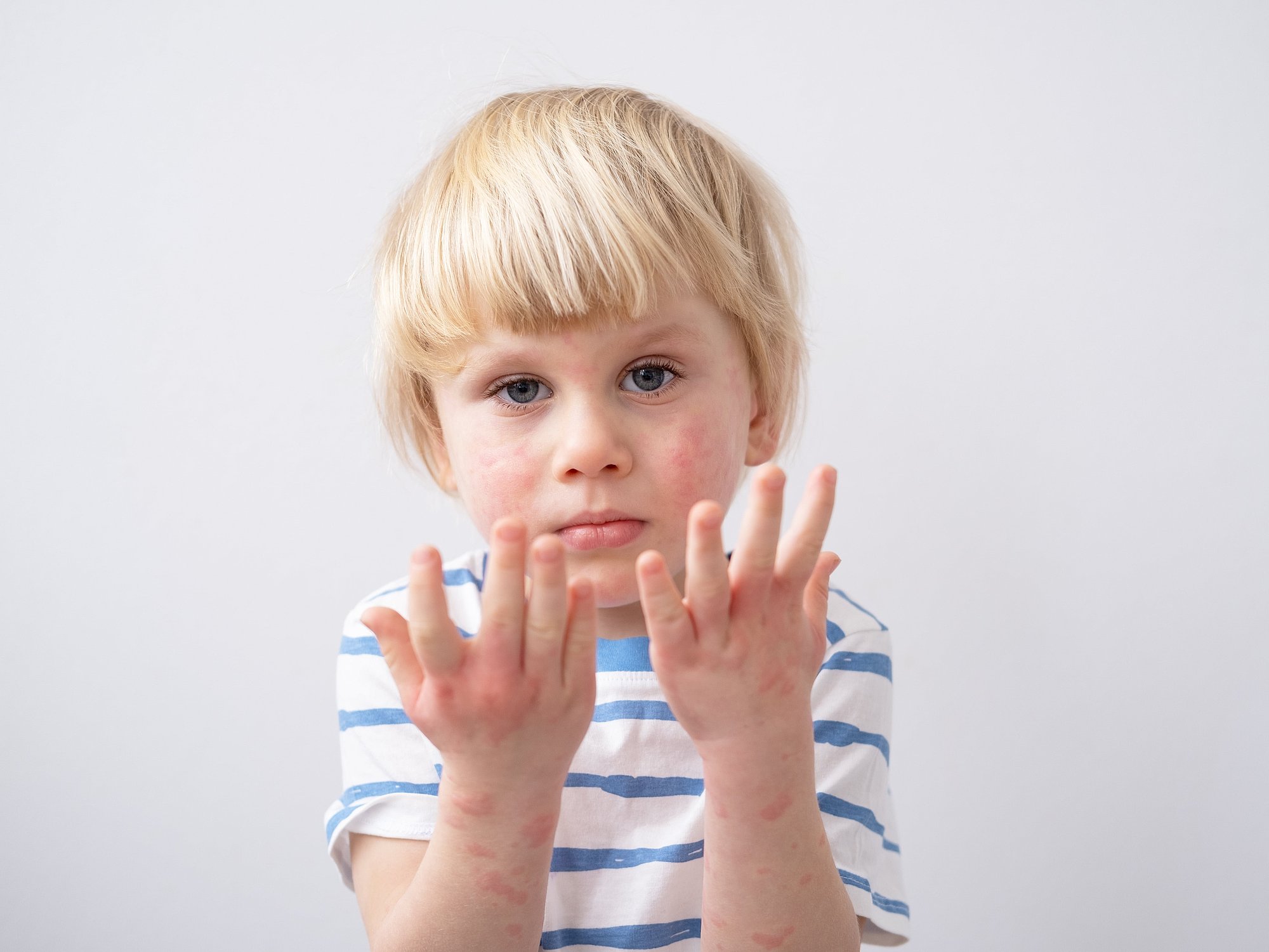 Atopische Dermatitis Bei Kindern Herausforderung F r Eltern Hautinfo at atopische-dermatitis-bei-kindern-herausforderung-f-r-eltern-hautinfo-at