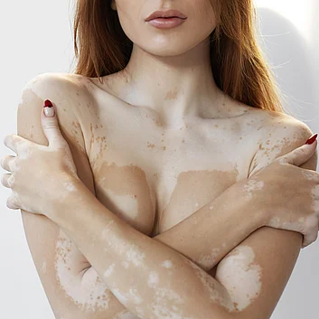 Vitiligo Weißfleckenkrankheit Ursachen und Behandlung