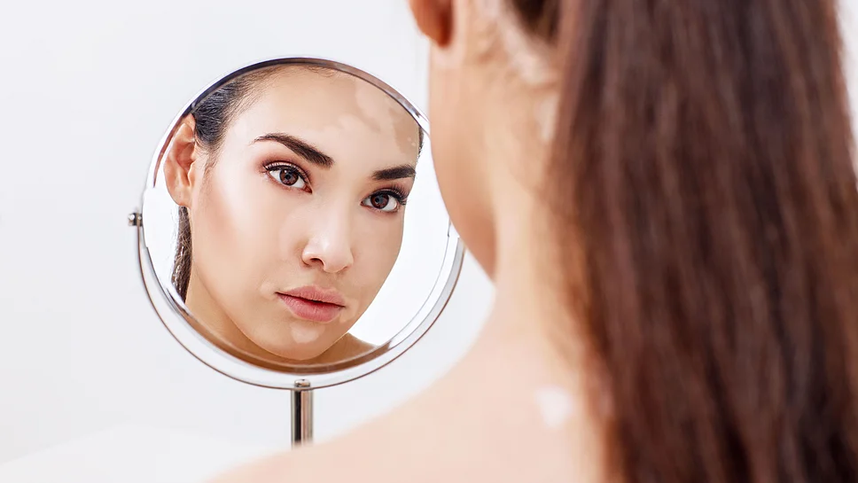 Vitiligo Weißfleckenkrankheit im Gesicht einer jungen Frau