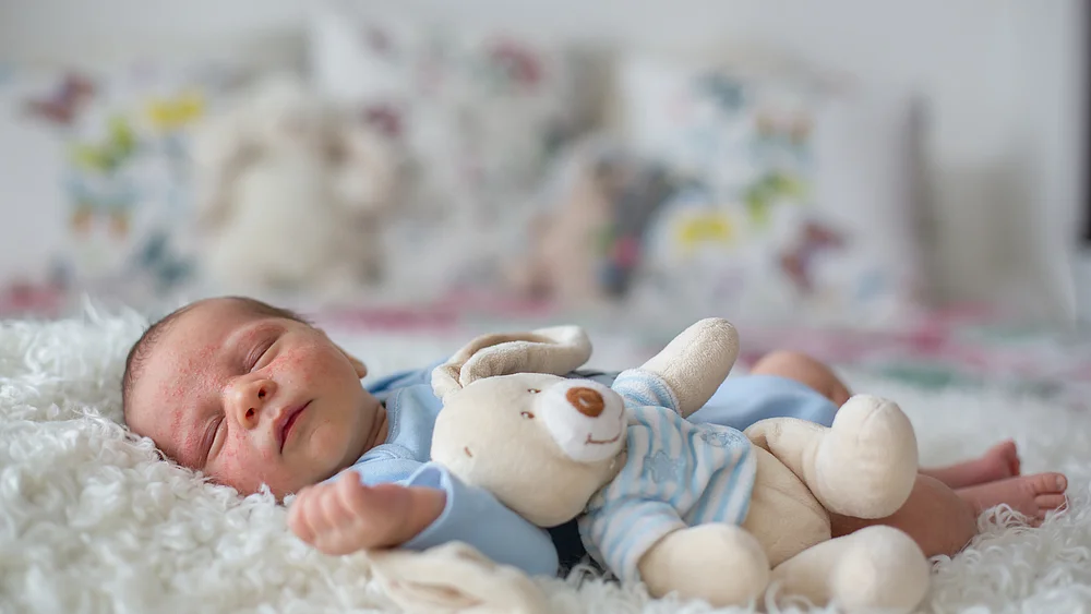 Babyakne Neugeborenenakne Säuglingsakne behandlung Tipps