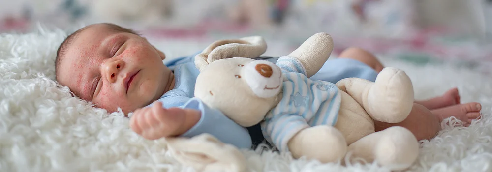Babyakne Neugeborenenakne Säuglingsakne behandlung Tipps