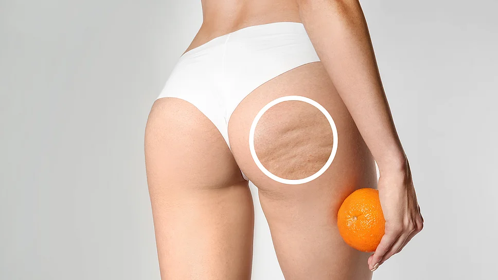 Cellulite Ursachen und Behandlung