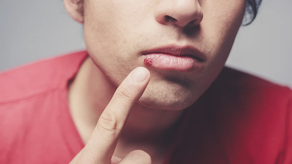 Fieberblasen bekämpfen Hilfe Herpes Viren