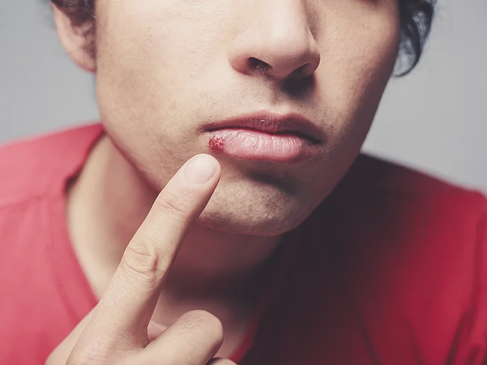 Fieberblasen bekämpfen Hilfe Herpes Viren