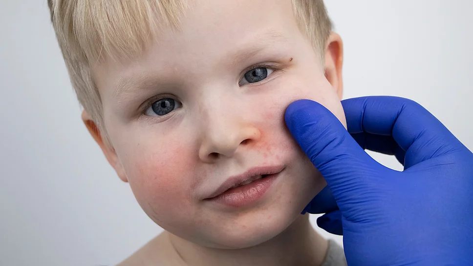 Dermatologe Kind Atopische Dermatitis Neurodermitis Untersuchung