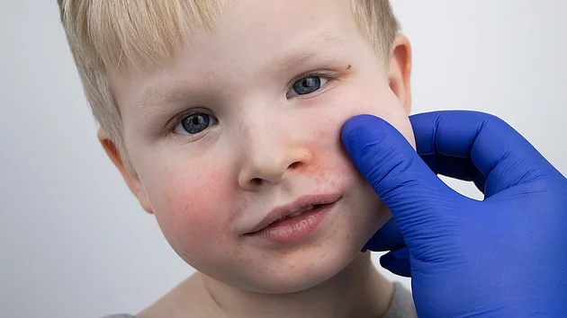 Dermatologe Kind Atopische Dermatitis Neurodermitis Untersuchung