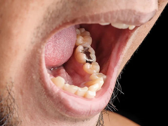 Amalgam Neurodermitis Ursache