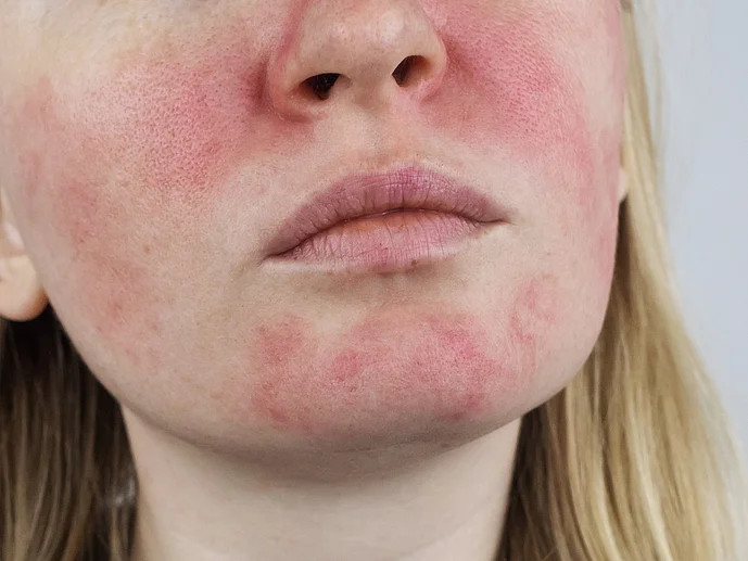 Rosacea Rosazea Gesicht