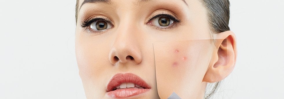 Hautprobleme Akne Hautpflege unreine Haut Spätakne